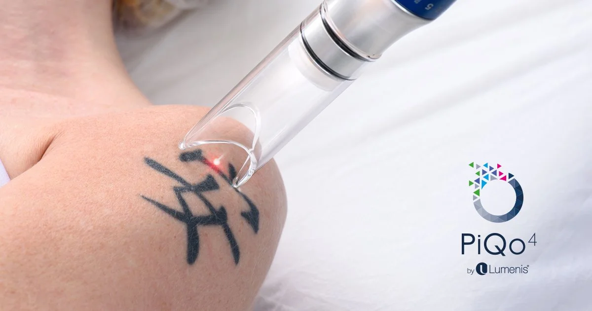 Laser for Tattoo Removal – Kiara Skin Clinic