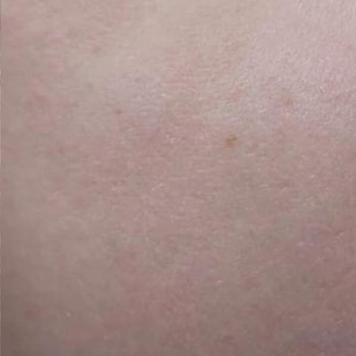 Melasma 4 sessions after