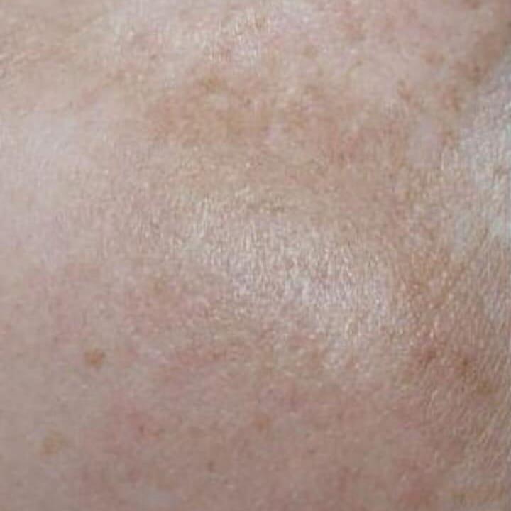 Melasma 4 sessions before