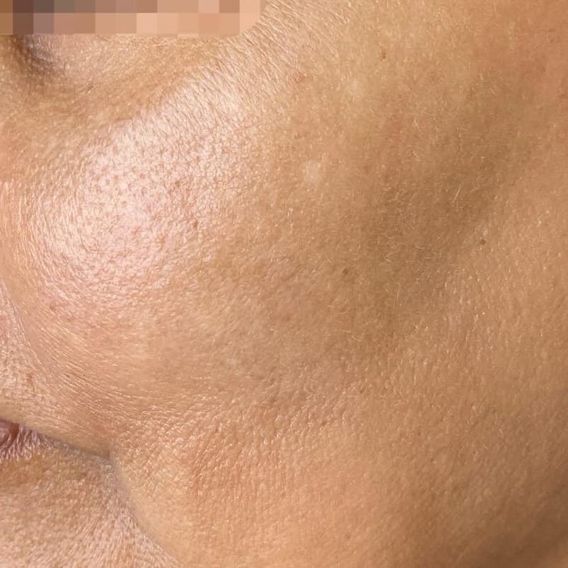 Melasma 6 sessions after