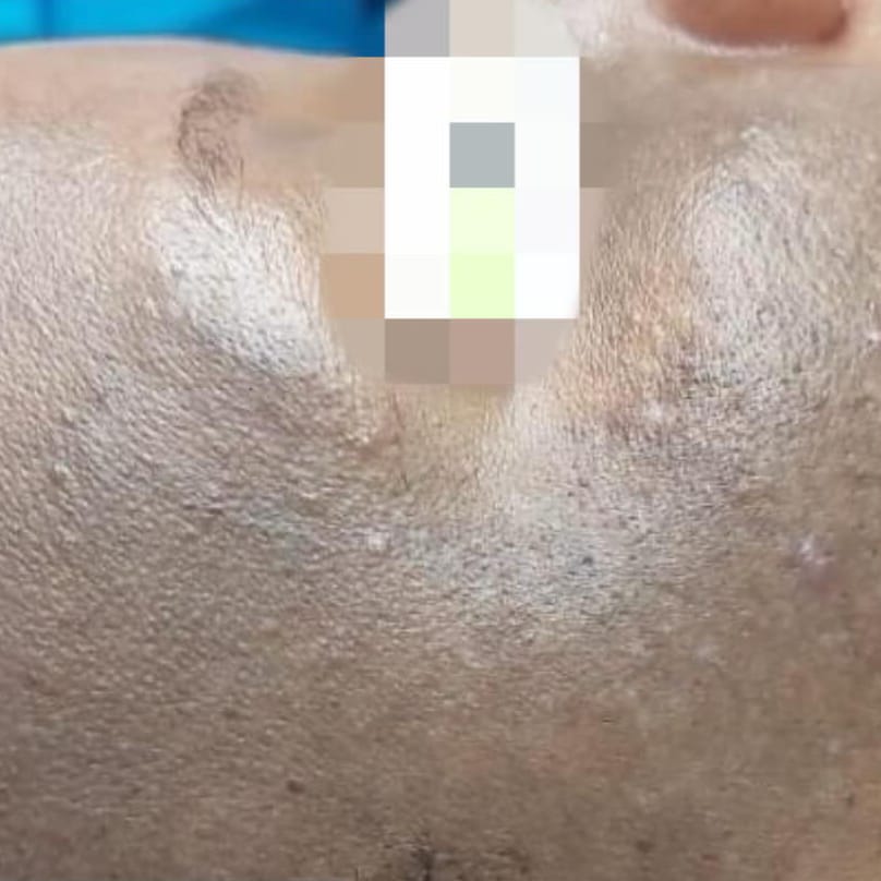 6 sessions of Melasma Laser After