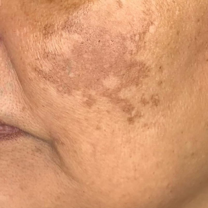 Melasma 6 sessions before